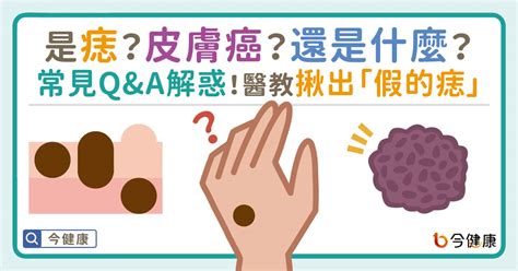 長毛的痣|是痣？還是皮膚癌？皮膚科醫師教你揪出「假的痣」，。